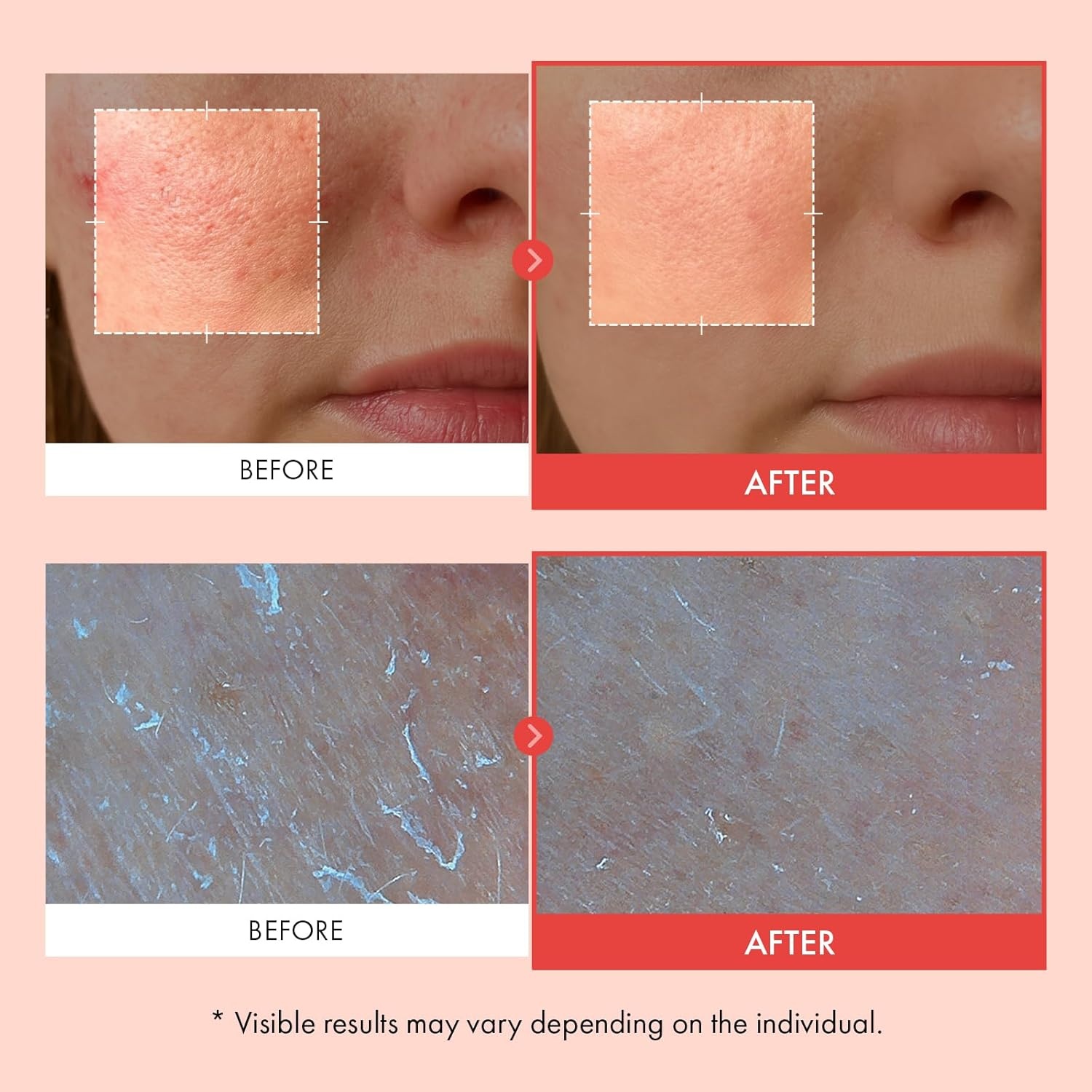 TOSOWOONG Microneedling-Effect & Hydration Bundle – Mandelic Acid Spicule Cream for Texture Improvement + Hyaluronic Acid 9 Daily Face Cream – Korean Skincare Set - view 3