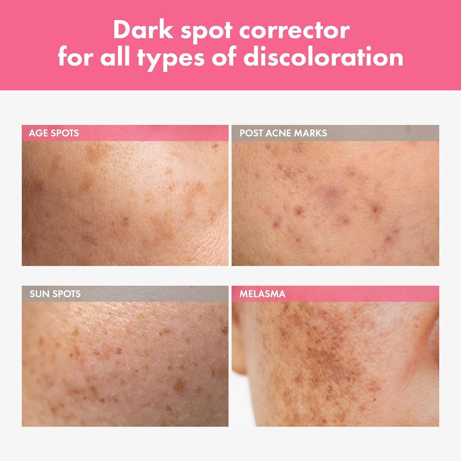 TOSOWOONG Advanced Anti-Pigmentation Solution Duo: Arbutin 7% Spot Cream & Niacinamide 10% Serum for Even Skin Tone