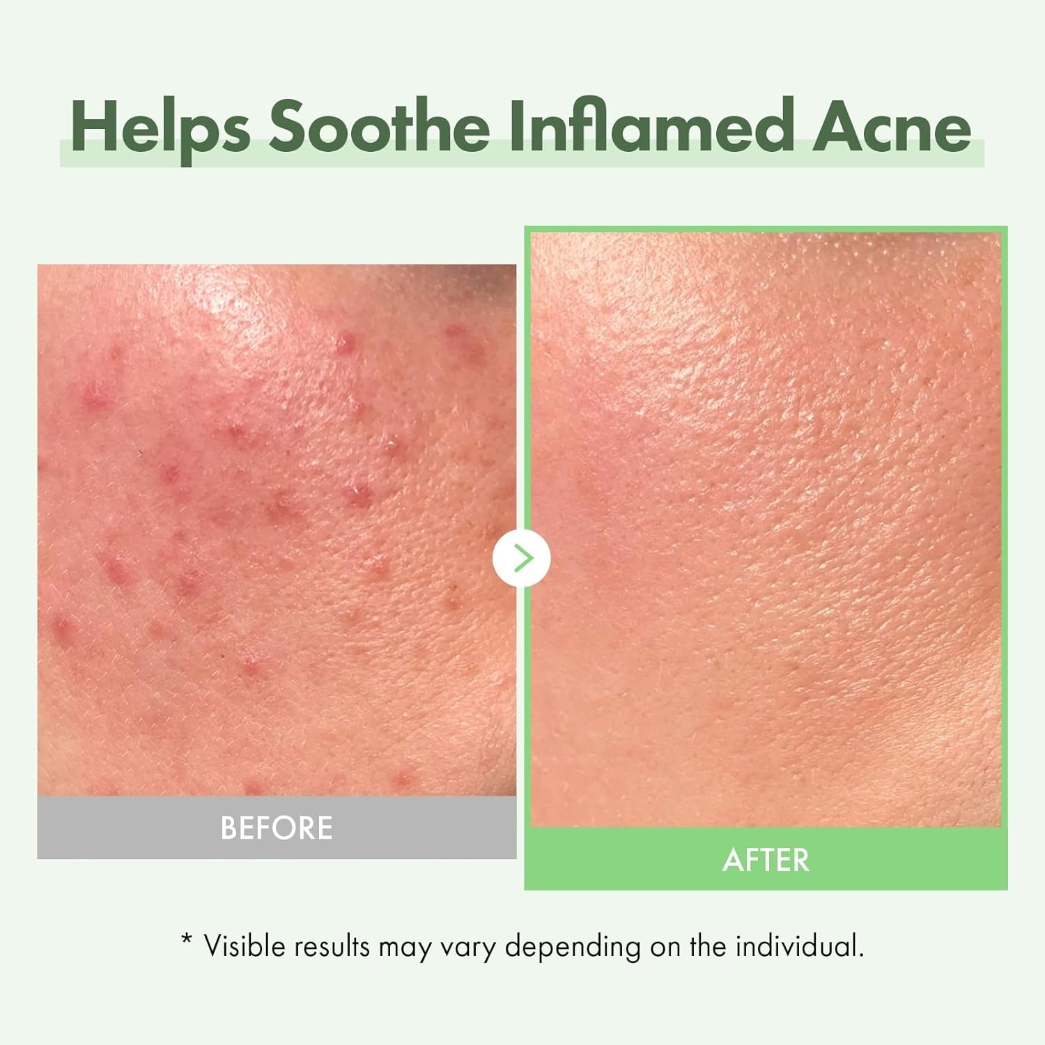Soothing & Hydrating Duo: TOSOWOONG Azelaic Acid 10% Face Serum & Real Relief Noni Ampoule for Clear, Radiant Skin - view 3