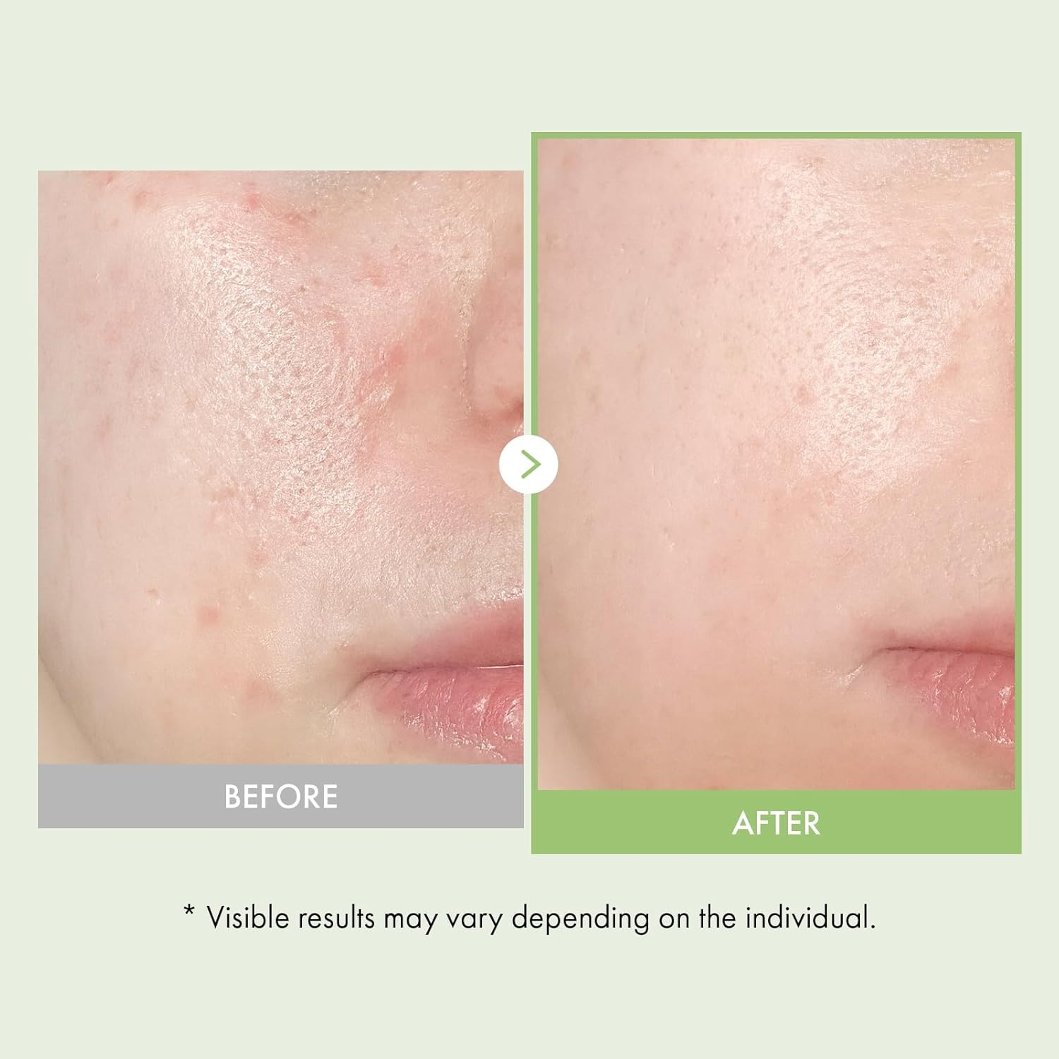 Soothing & Hydrating Duo: TOSOWOONG Azelaic Acid 10% Face Serum & Real Relief Noni Ampoule for Clear, Radiant Skin - view 5
