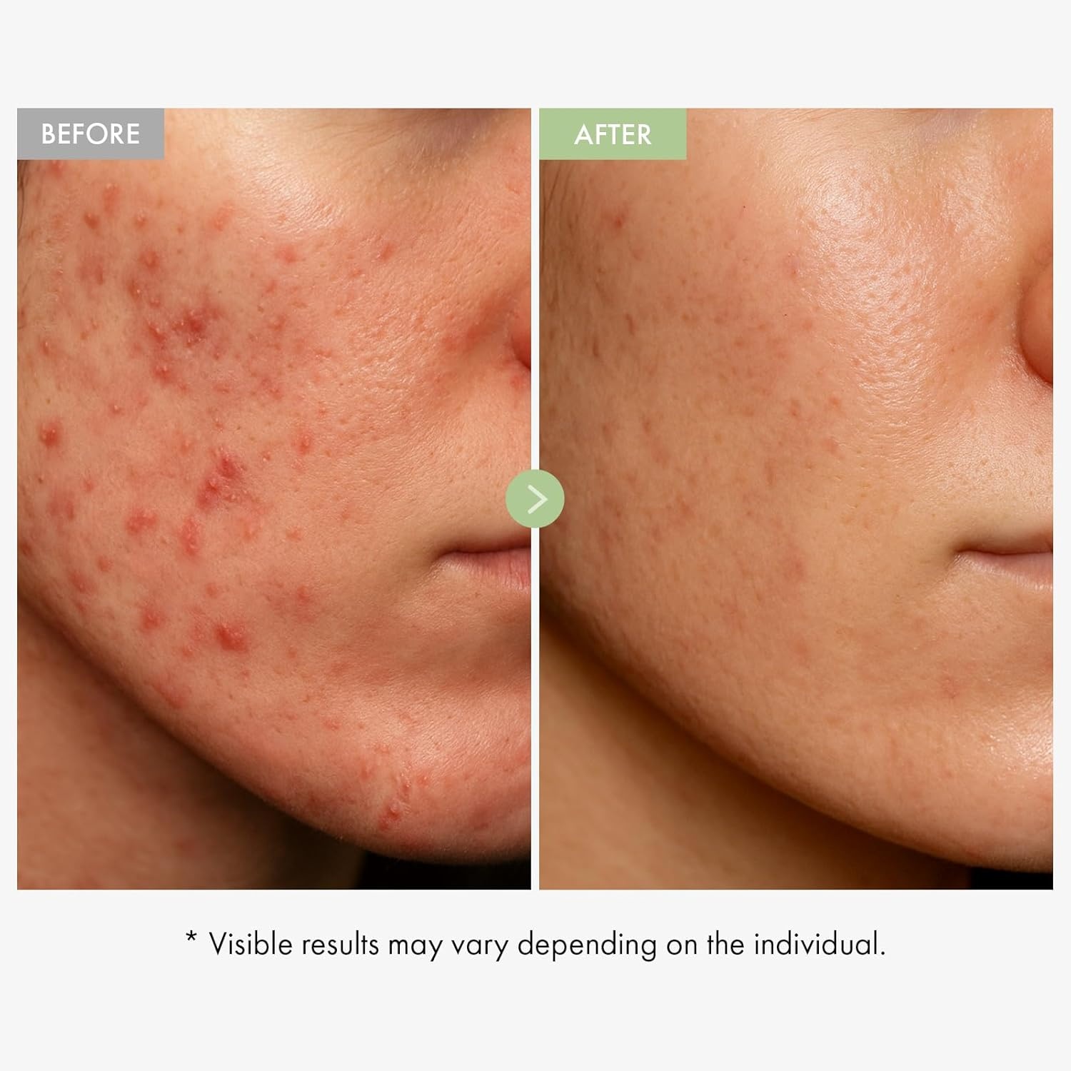 TOSOWOONG K-Beauty Calming Duo Cica Cream and Azelaic Acid Serum - view 3