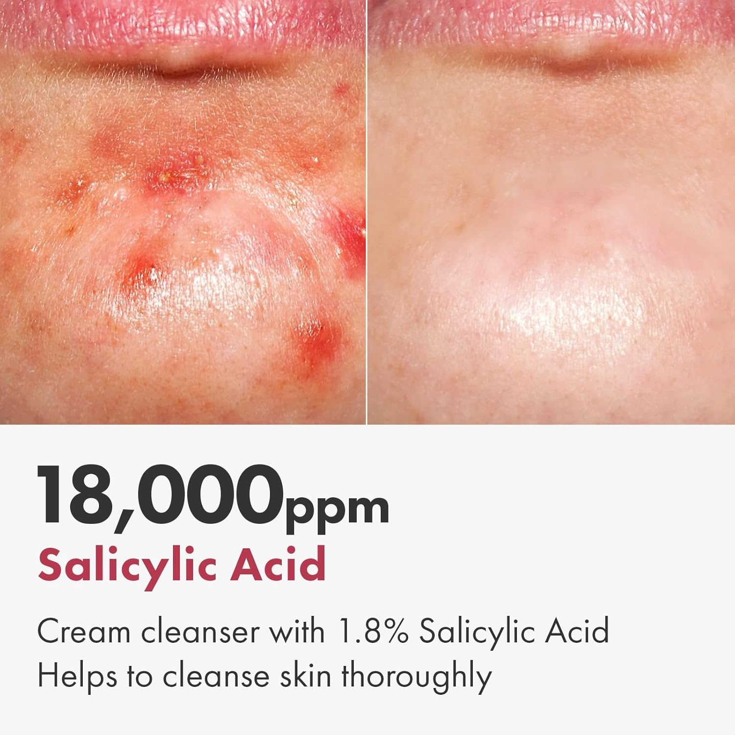 TOSOWOONG Salicylic Acid Foam Cleanser for Oily Skin, 18,000ppm Salicylic Acid, Deep Pore Cleansing, Face Wash For Breakouts, Exfoliating Cleanser, Korean Skin Care, 100ml, 3.38 fl. oz. - view 2