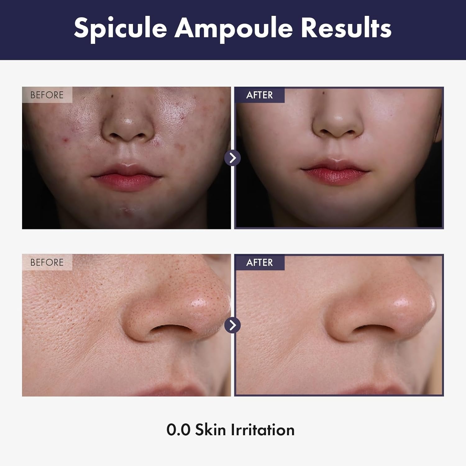TOSOWOONG Real Spicule Ampoule with 30,000 Shots, Niacinamide, Panthenol, Liquid Skin Booster Serum, Pore Minimizer, Exfoliating, Dead Skin Cells, Skin Texture, Korean Skincare, 30ml, 1.01 fl. oz.