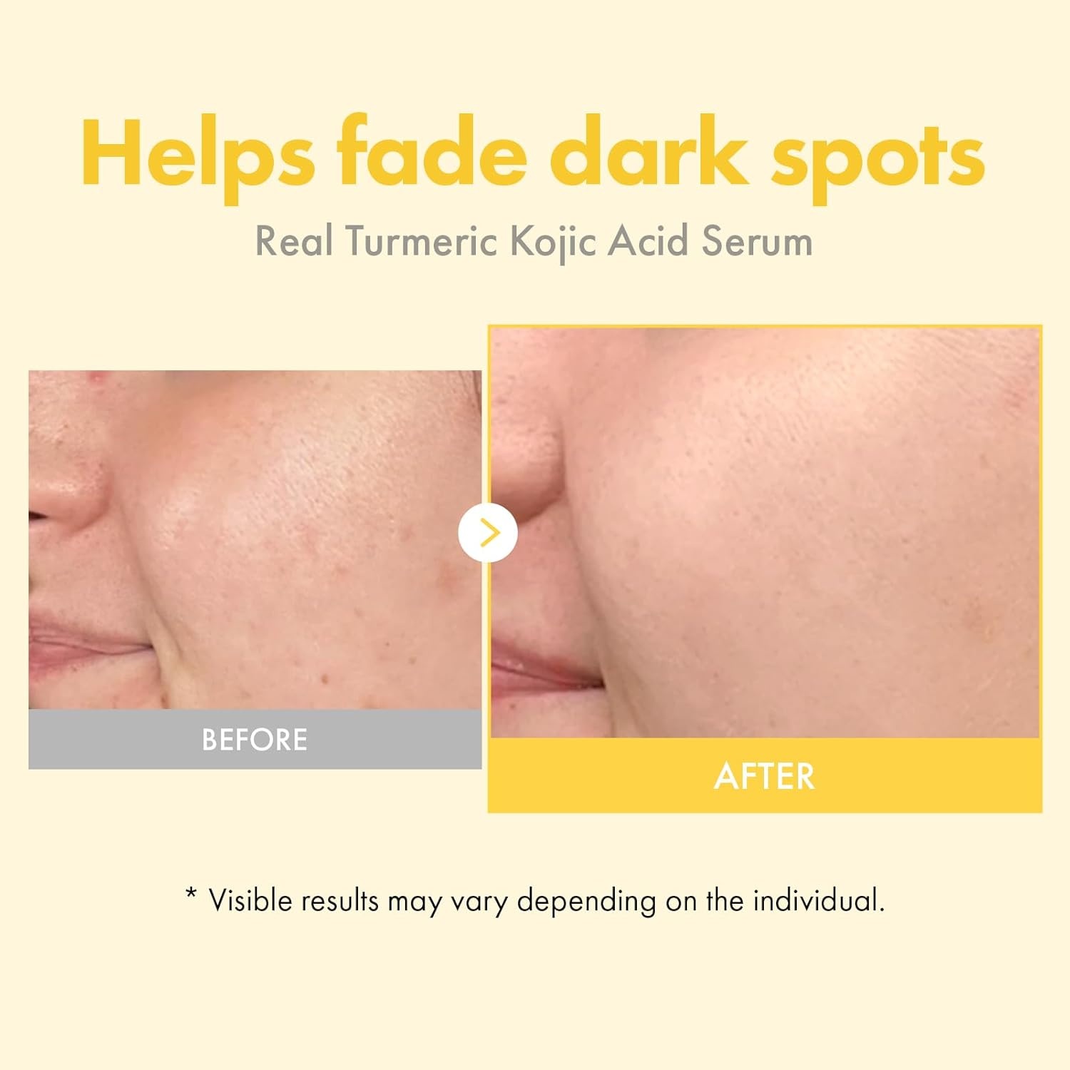 TOSOWOONG Real Turmeric Kojic Acid Serum – Brightening serum 7,000ppm Kojic Acid, 1,500ppm Turmeric, Alpha Arbutin, Astaxanthin, Glycolic Acid, Dark Spots, Freckle, Korean Skin Care, 33ml/1.11 fl.oz. - view 3