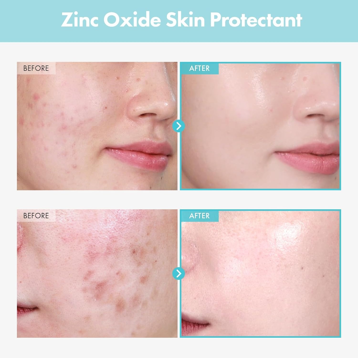 TOSOWOONG Zinc Oxide 10 Cream, 100,000ppm Zinc Oxide, Heal, Soothe Acne, Redness, Rosacea Treatment, Skin Barrier Repair, Moisture, Non-Comedogenic, Korean Skincare, 50g, 1.76 oz. - view 2