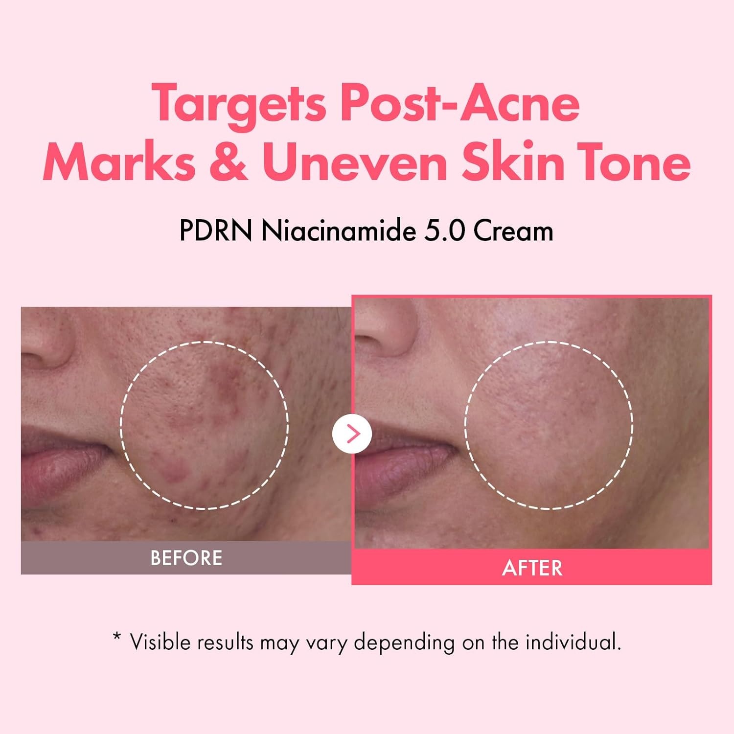 TOSOWOONG PDRN Niacinamide 5.0 Cream, Niacinamide 5% Dark Spot Remover for Face, Hyperpigmentation & Blemish Care, Salmon DNA Hydrating Moisturizer, Korean Skincare, 50ml / 1.69 fl. oz.